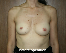 plastic-surgery-breast-augmentation